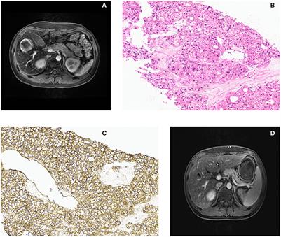 Case Report: An Undefined Liver Lesion in a Young Man With Severe Aplastic Anemia: A Teachable Moment